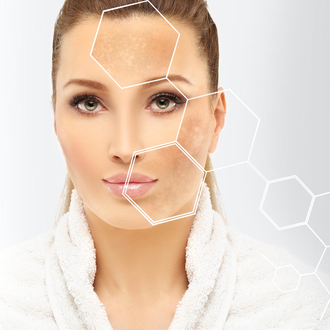 Chemical Peels1_small