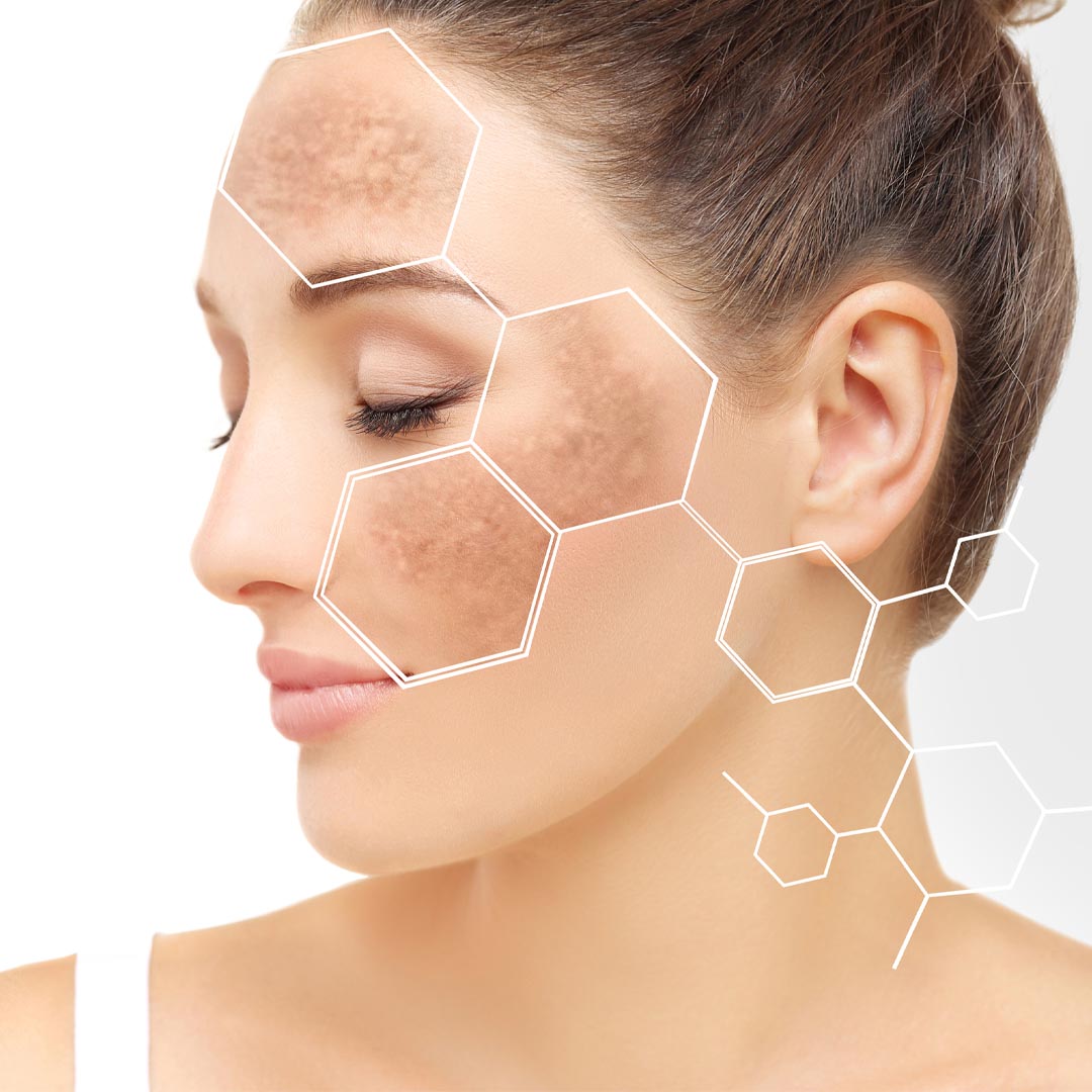 Chemical Peels_small