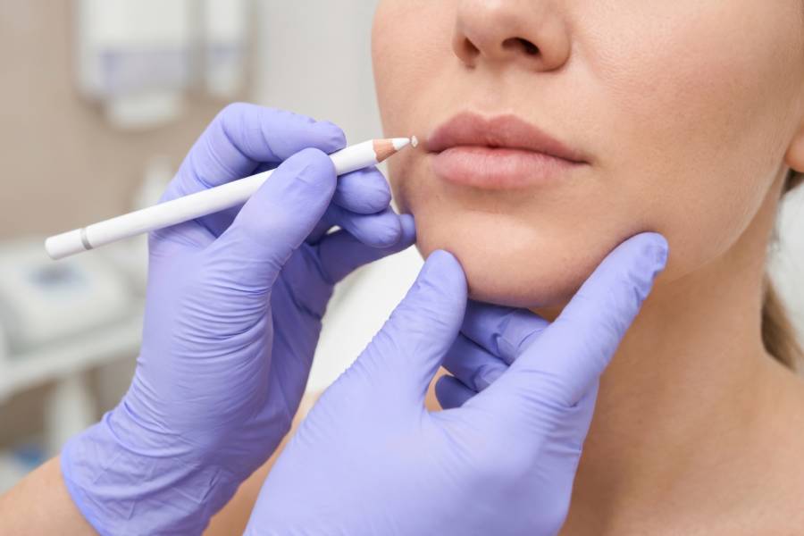 Professional marking patient's mouth for lip filler treatment to enhance shape and symmetry