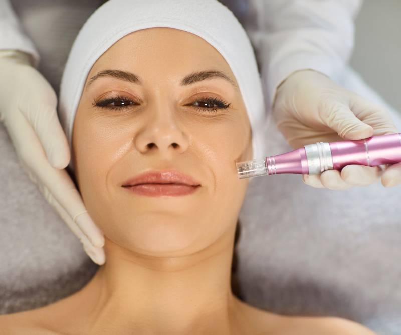 microneedling10 Microneedling